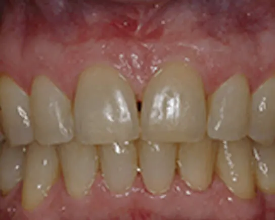 Frenectomy After Treatment