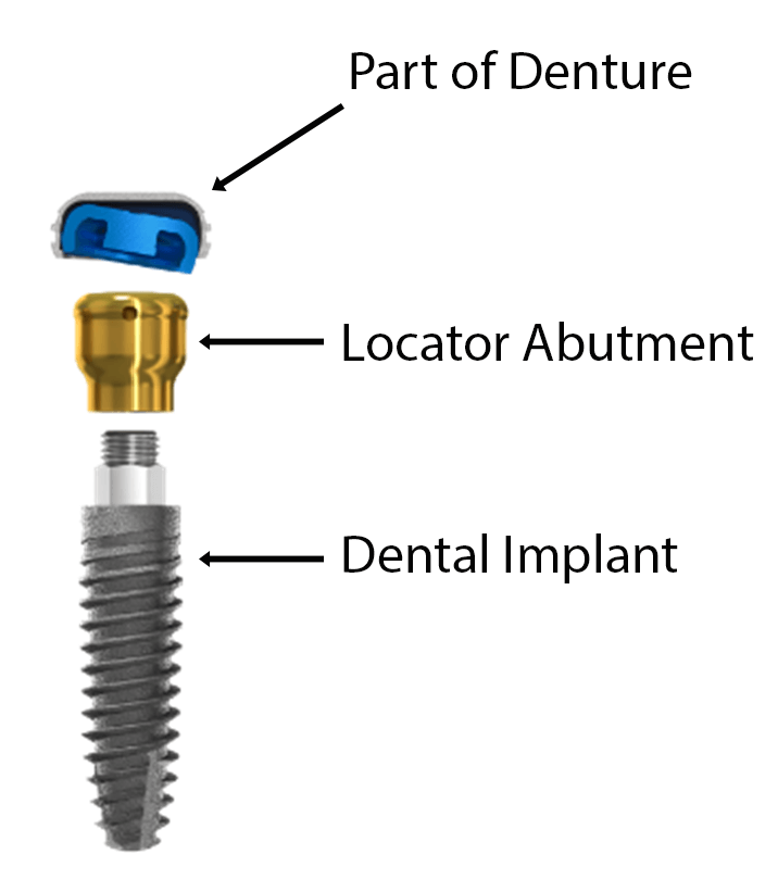 Snap on Denture Implant Illustration