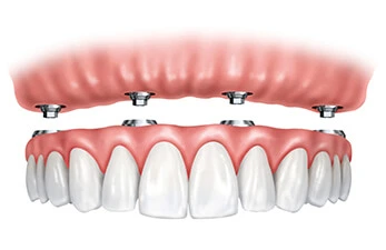 Permanent Replacement of Teeth