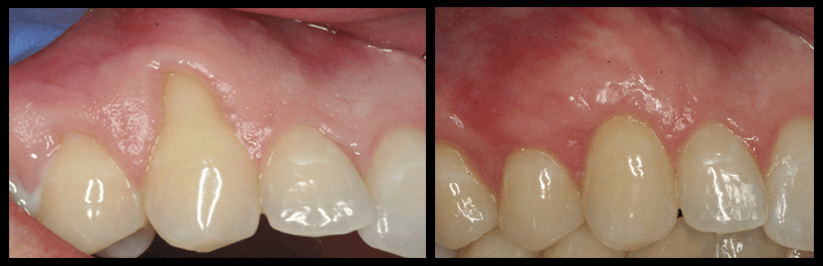 Gum Grafting Before And After Images