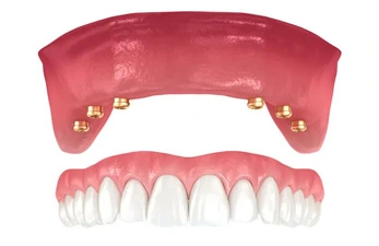 Snap-in Dentures