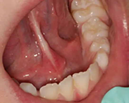 Tongue-tied After Treatment