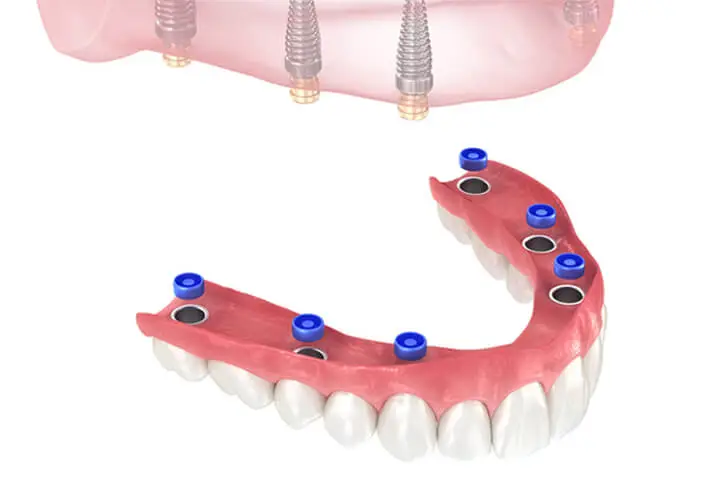 Overdenture Replacement Rings